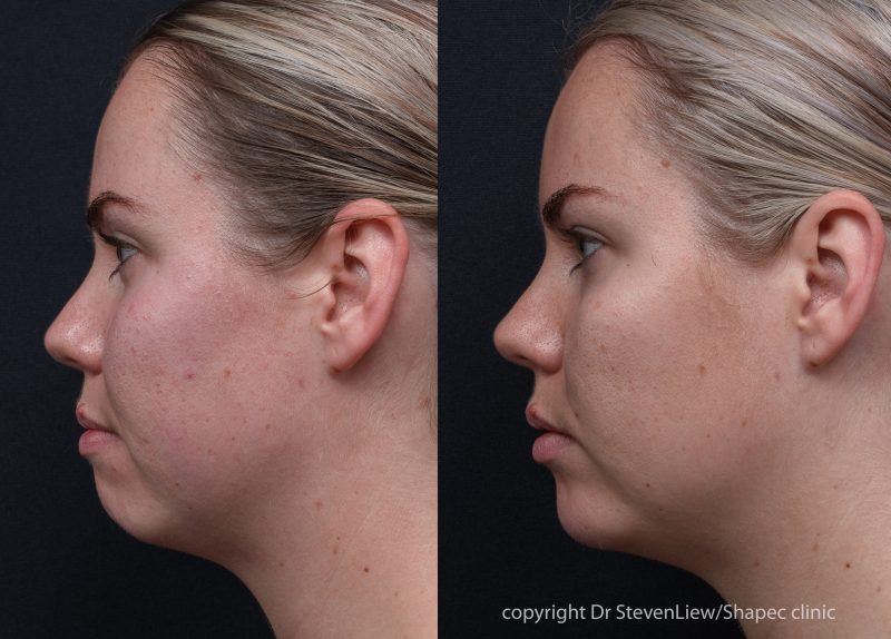 Before and after dermal filler treatment in the cheeks