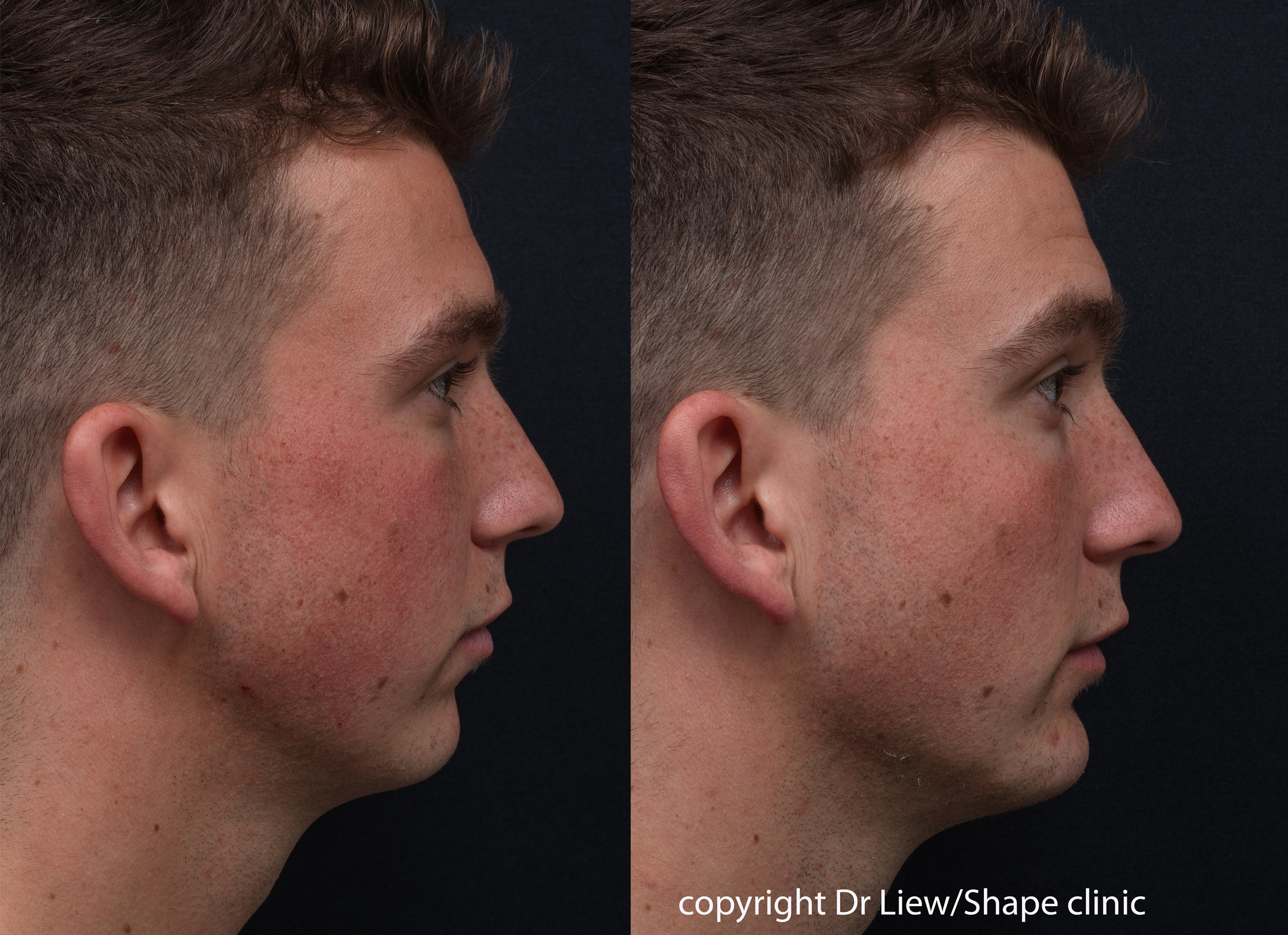 Before and after dermal filler treatment in the chin