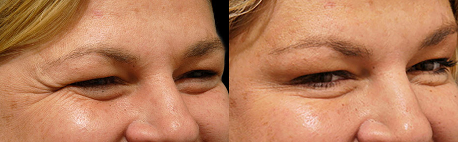Before and after anti wrinkle injections to crows feet