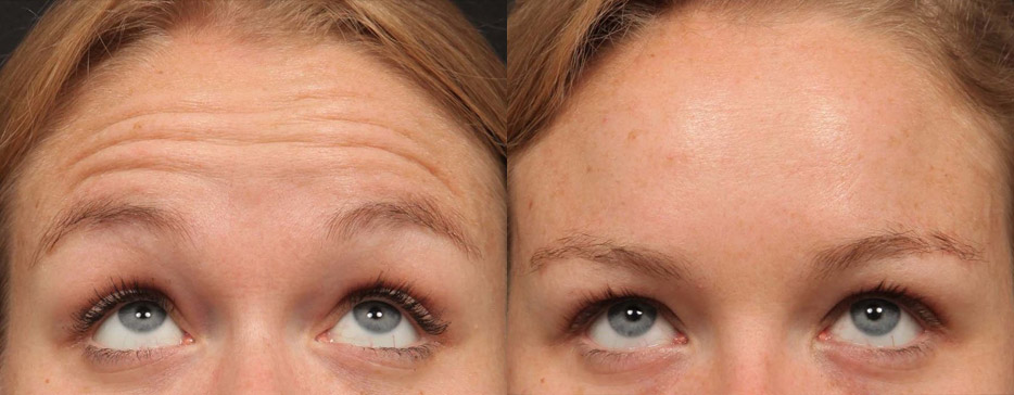 Before and after anti wrinkle injections to the forehead