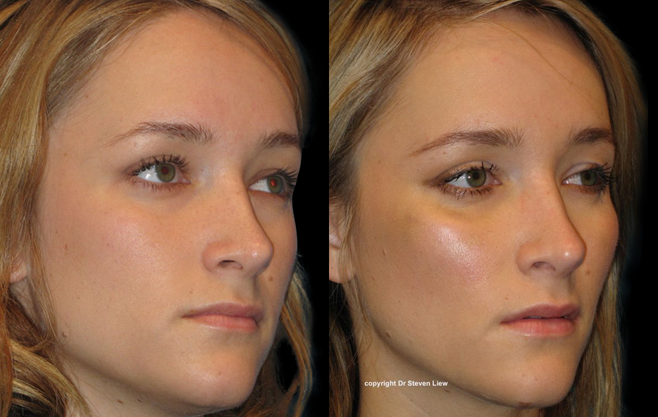 Before and after dermal filler injections in the cheek and chin