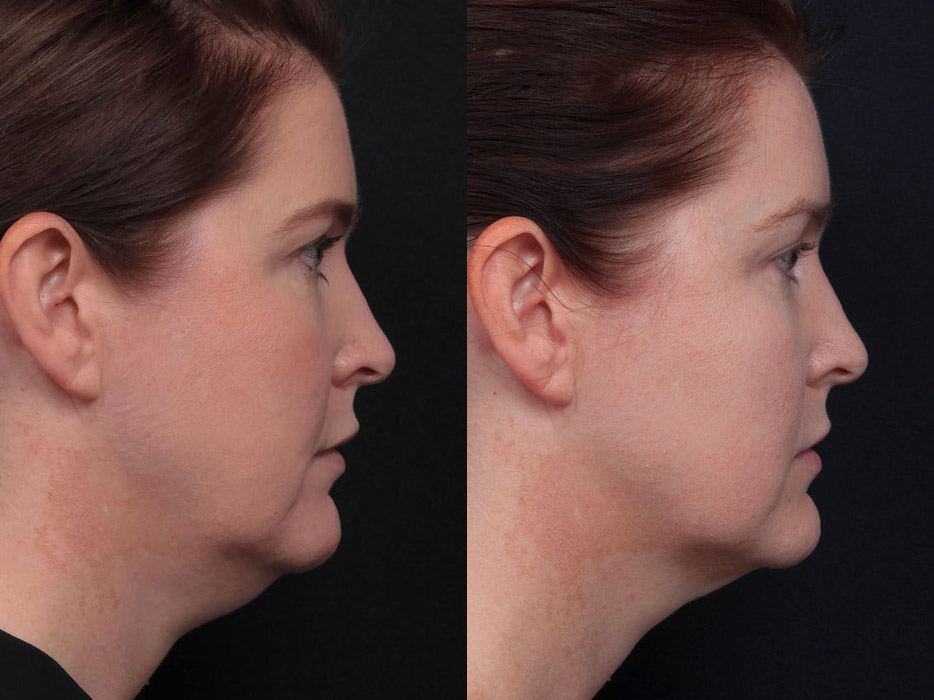 Before and after double chin injection treatment