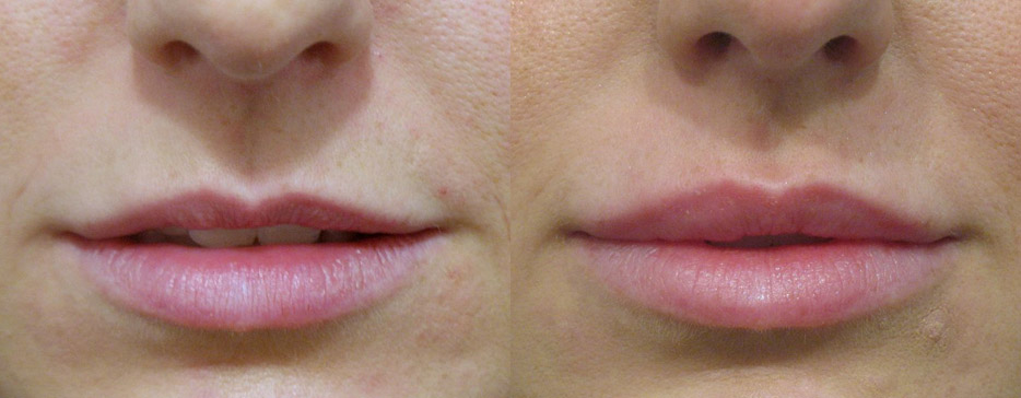 Lip augmentation before and after results