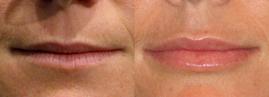 Lip enhancement before and after results