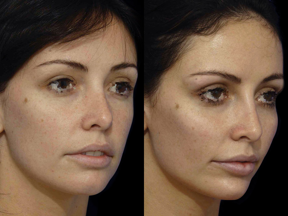 Before and after results for total face enhancement using dermal fillers