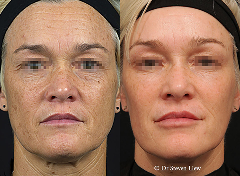 Total Face Enhancement results