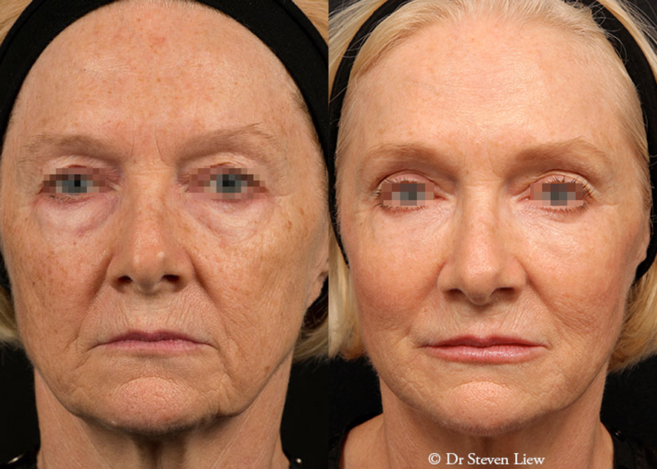 Total Face Enhancement results