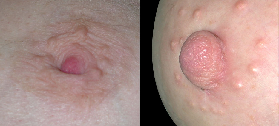 What do Inverted Nipples Mean? Causes and Treatment