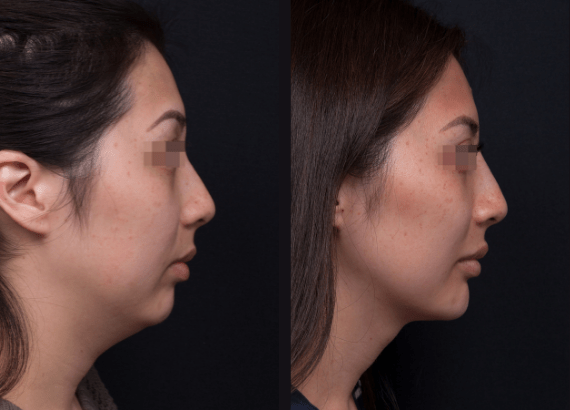 Total Face Enhancement results