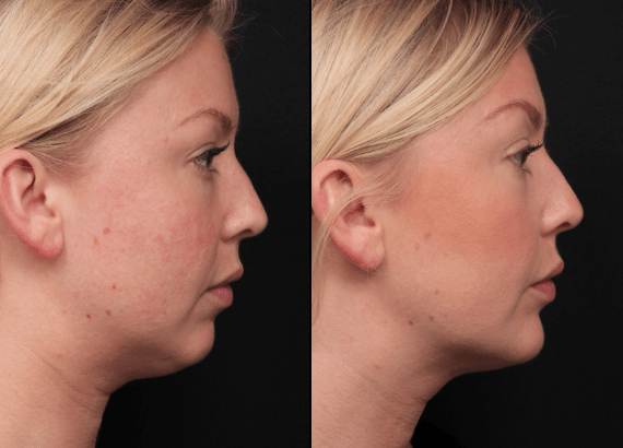 Before and after double chin injection treatment