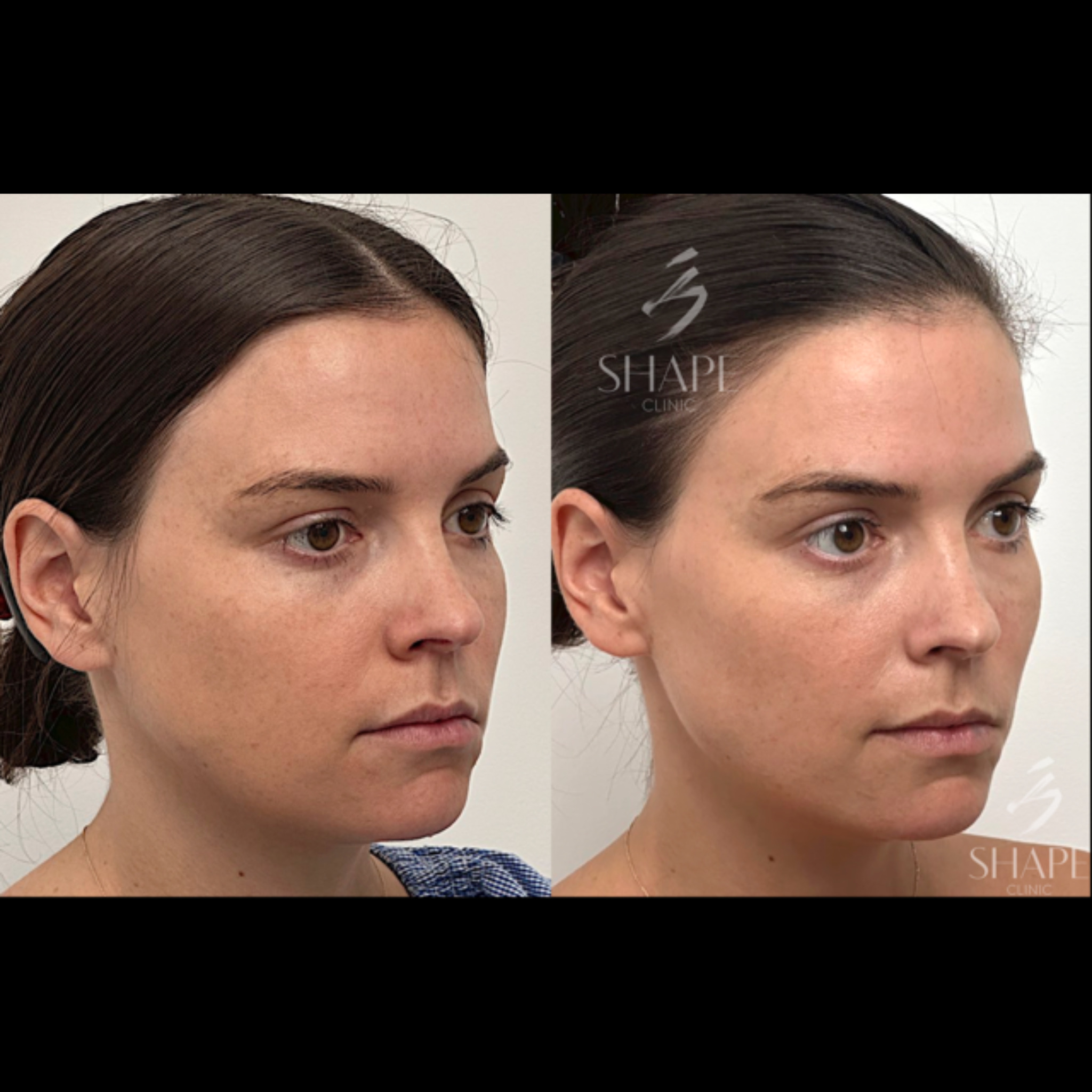 EMFACE treatment before and after results