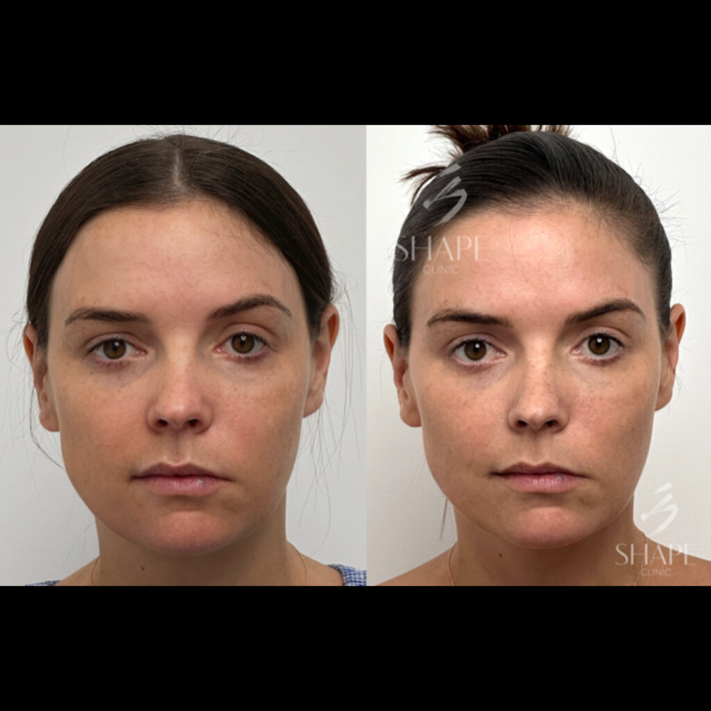 emface-sydney-non-surgical-facial-lifting-toning