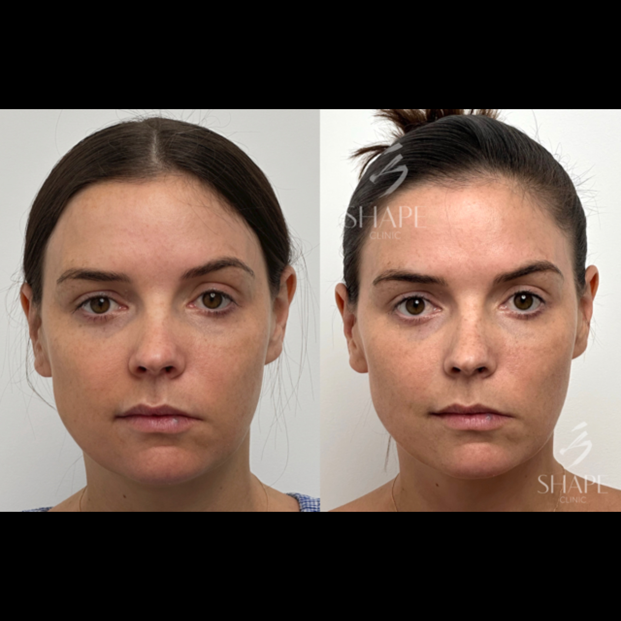 EMFACE treatment before and after results