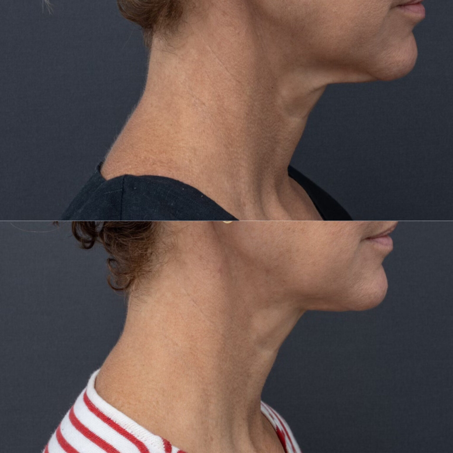 Myellevate minimally invasive neck lift in sydney