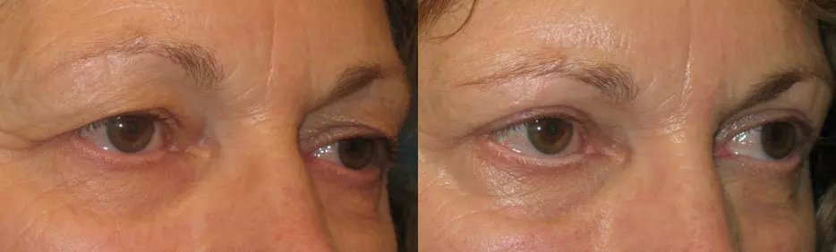 eyelid surgery before and after results
