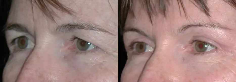 Eyelid Lift Surgery before and after results