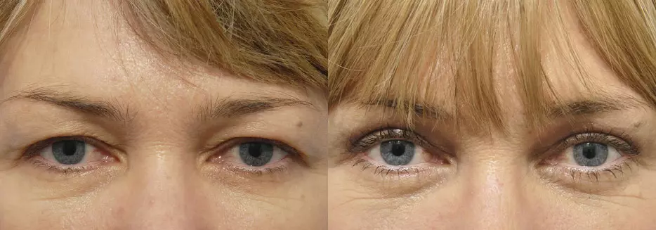 Eyelid Lift Before and After