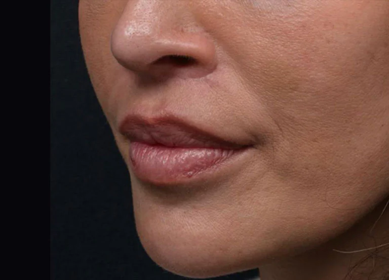 Close-up of a woman's lower face highlighting lips and jawline with natural skin texture against a dark background.